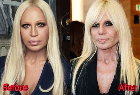 donatella versace avant operation|donatella versace avant après.